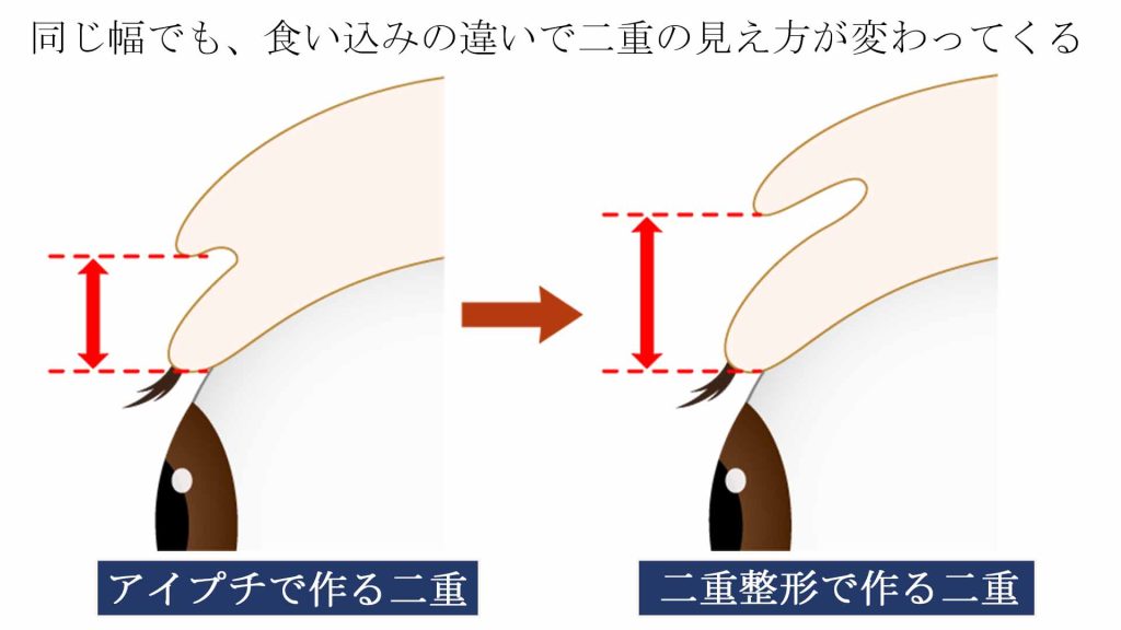 アイプチで作る二重と整形で作る二重の違い